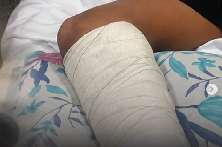 Menino de 11 anos atropelado na calçada em Barra do Garças sofre fraturas e família pede ajuda para custear tratamento