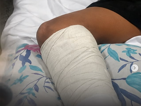 Menino de 11 anos atropelado na calçada em Barra do Garças sofre fraturas e família pede ajuda para custear tratamento